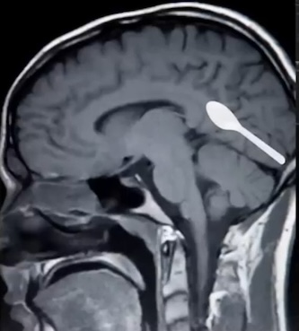 Microplastics silent invasion